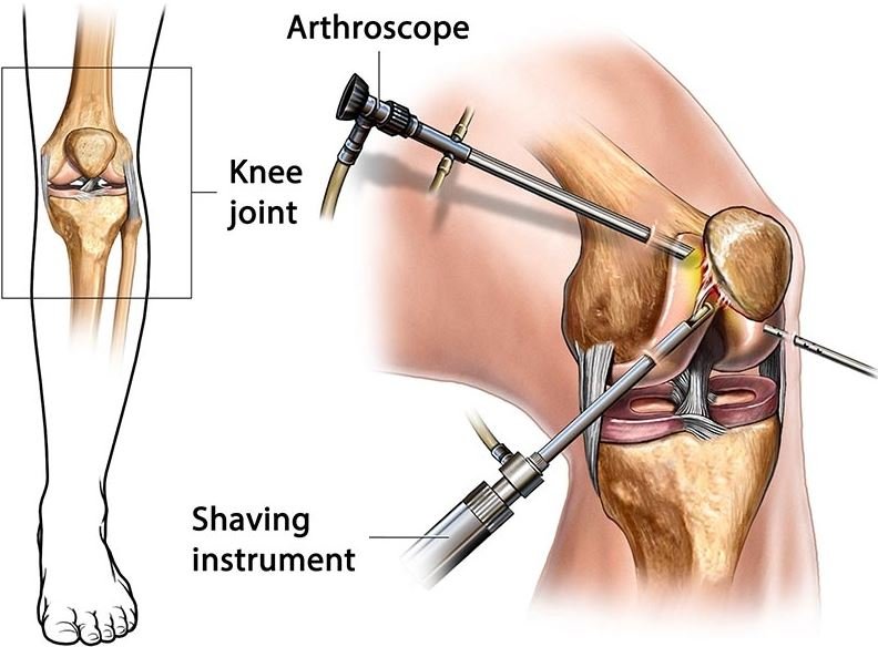 Arthritis and Joint Replacement